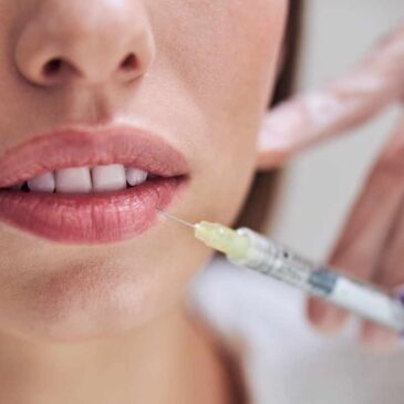 Fillers con Ácido Hialurónico