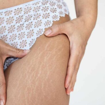 Carboxiterapia, Perfect Beauty®